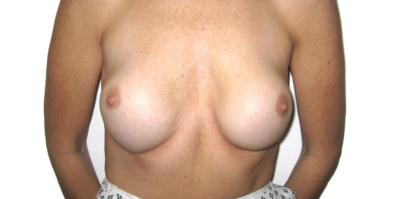 Before complex breast enlargement procedure showing  breast  
